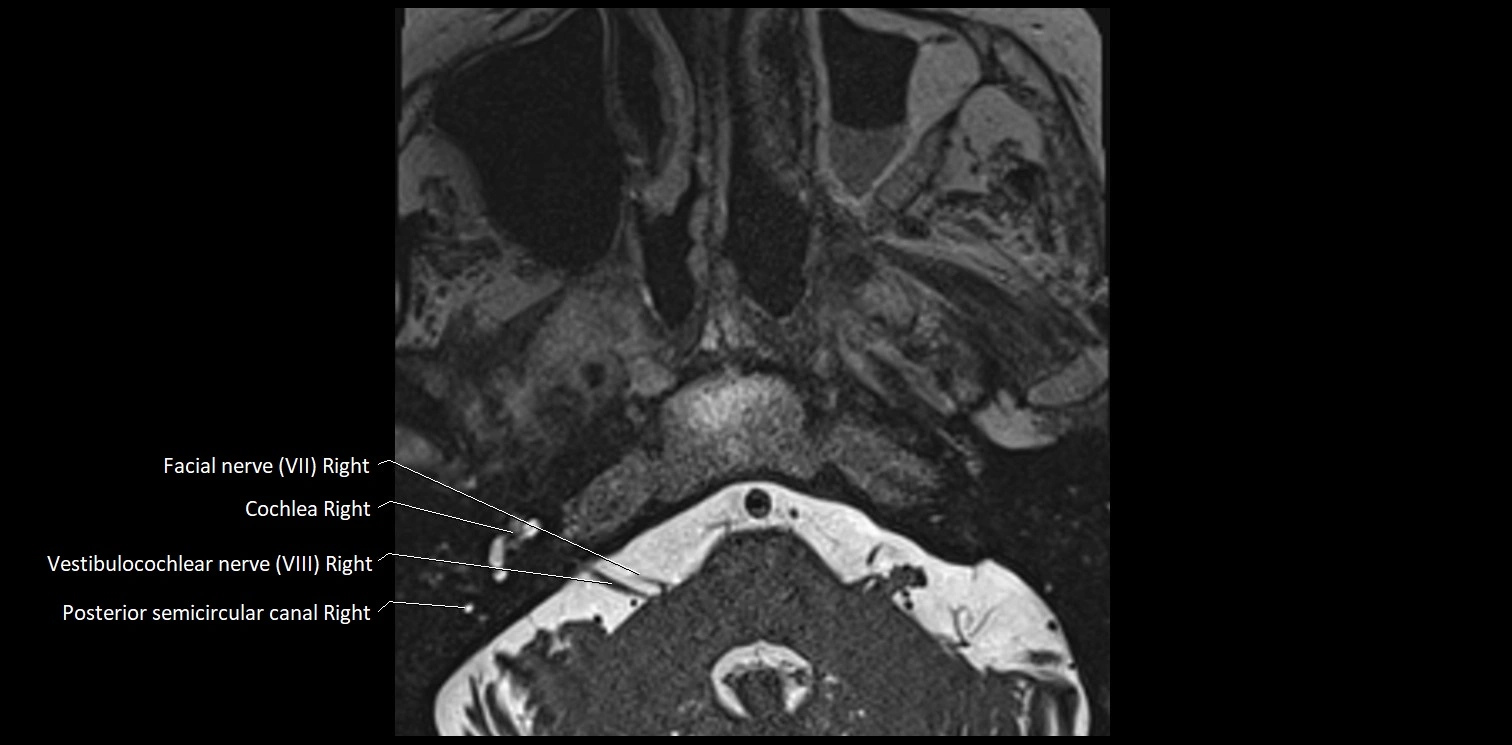 Cranial nerve anatomy axial MRI 3T image 60.webp